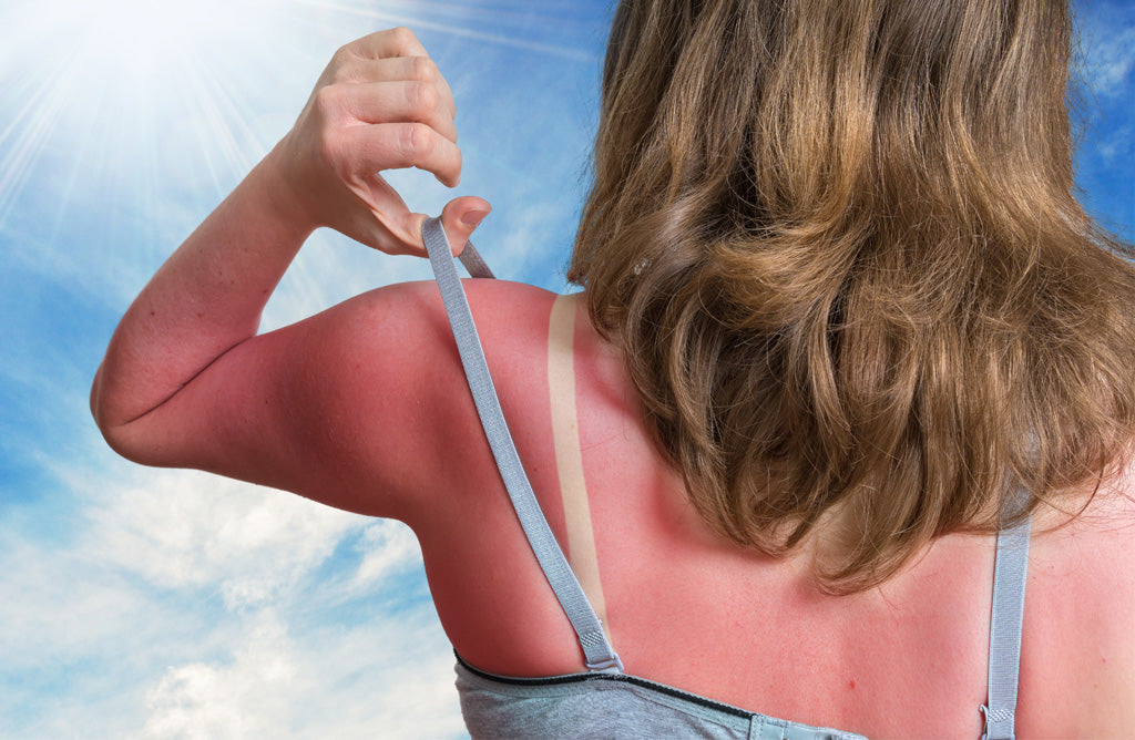 Tips for Caring for your Sunburn