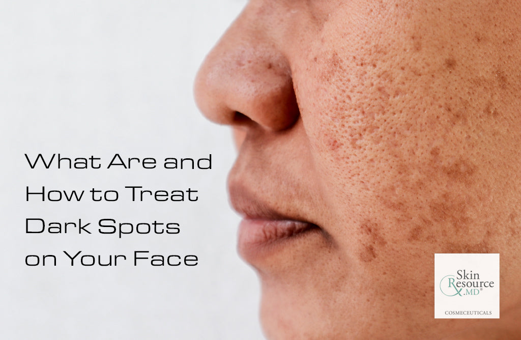 What Are and How to Treat Dark Spots On Your Face.